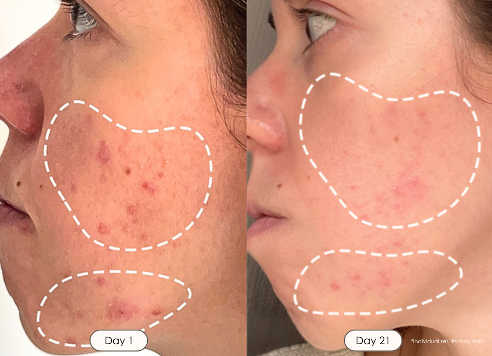 LightAura Flex LED Face Mask infrared and blue light therapy before and after results showing improvement on acne within 30 days