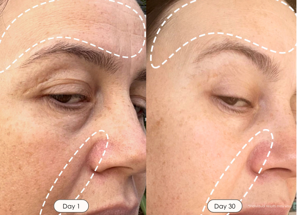 Reinvo Facial Microdermabrasion Wand before and after results showing reduced wrinkles fine lines and brighter complexion