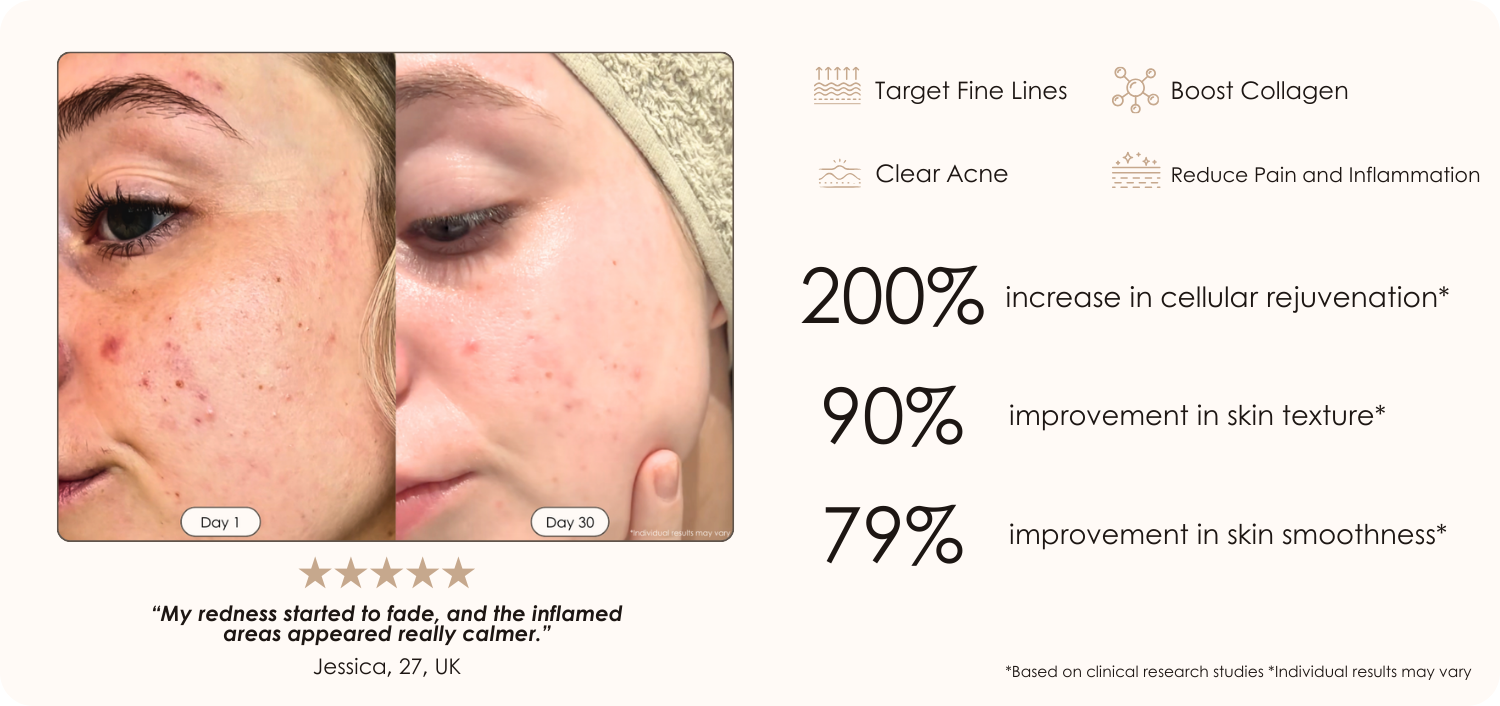 LumaLux LED light therapy dome before and after where there is less redness and the skin looks calmer after 30 days of use with additional benefits and statistics