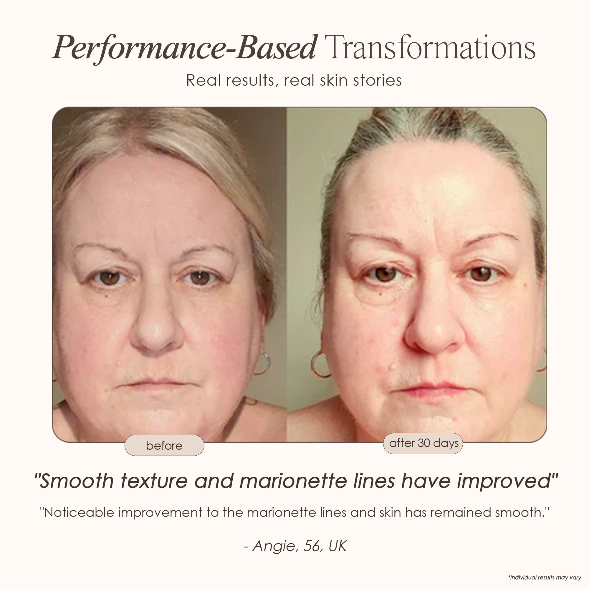 Lumamask Pro LED light therapy face mask before and after where marionette lines have improved after 30 days