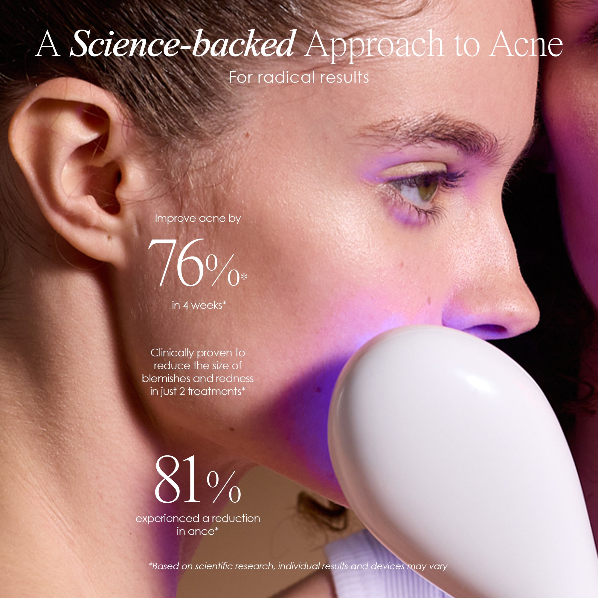 LumaGlow Blue anti-acne wand clinical research statistics of blue LED light therapy